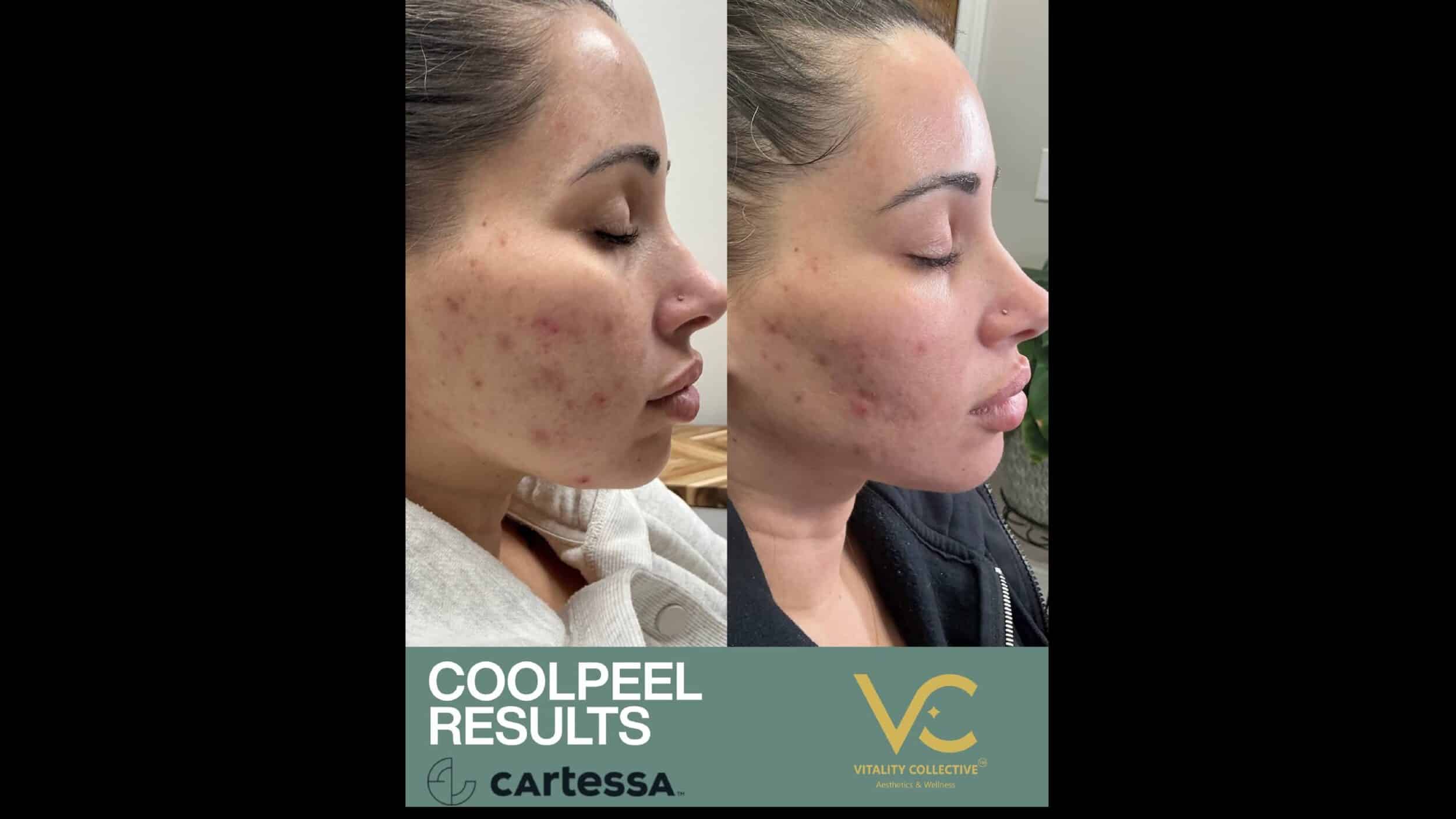 Before and After Image: CoolPeel - right-side