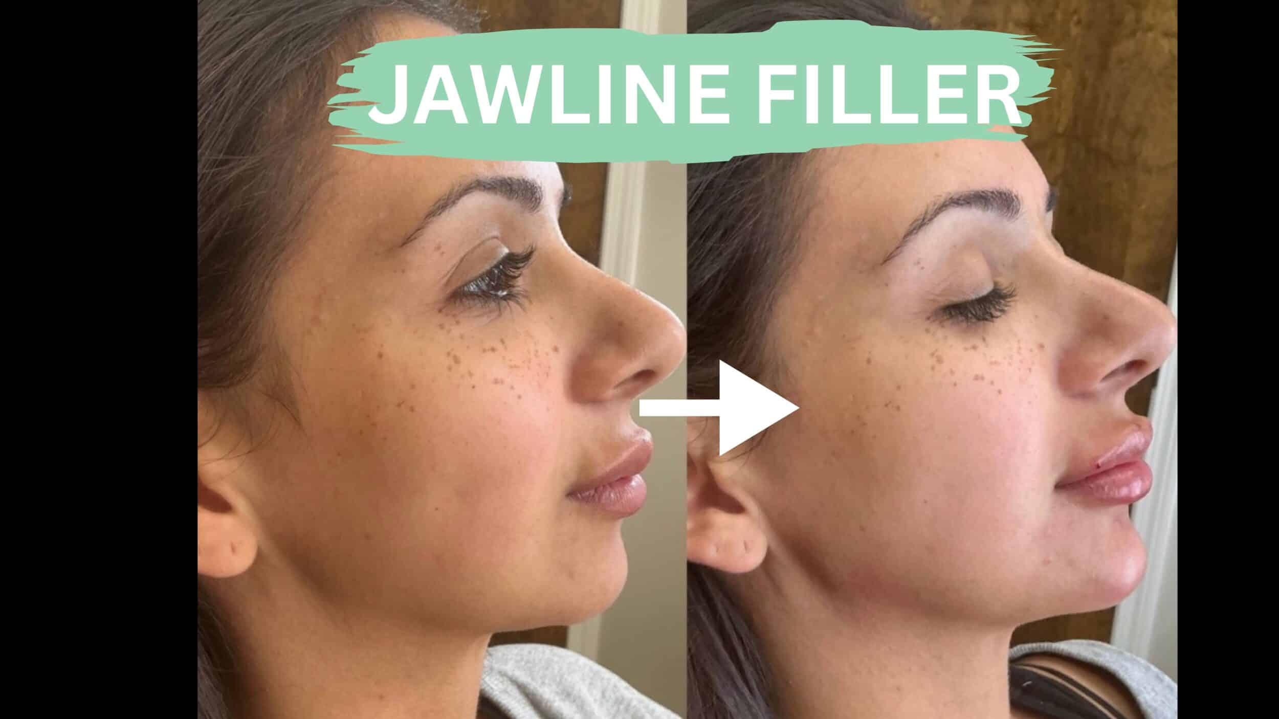 Before and After Image: Jawline Filler - right-side