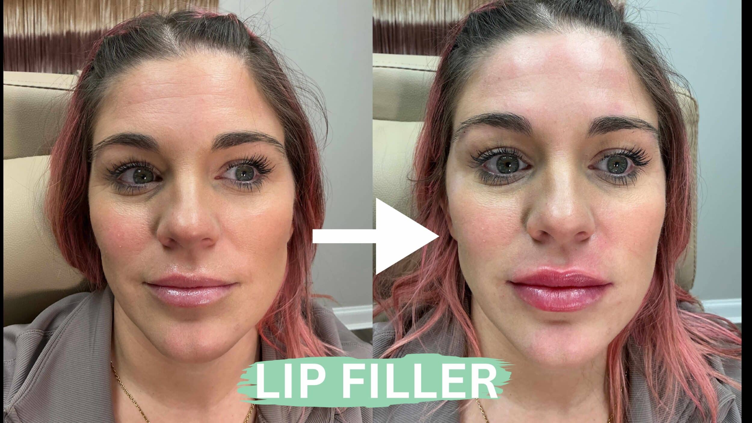 Before and After Image: Lip Filler - front