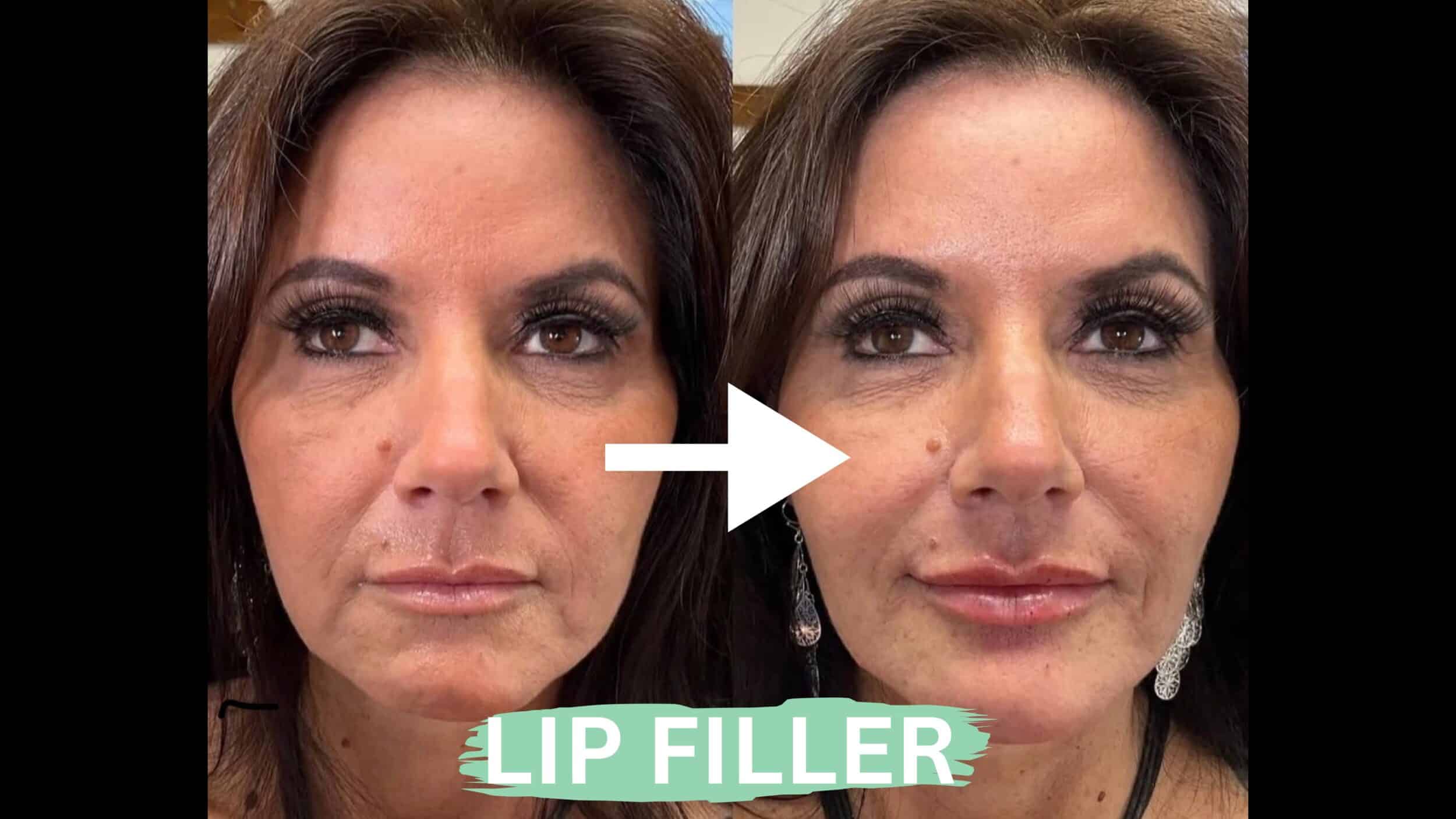 Before and After Image: Lip Filler - front