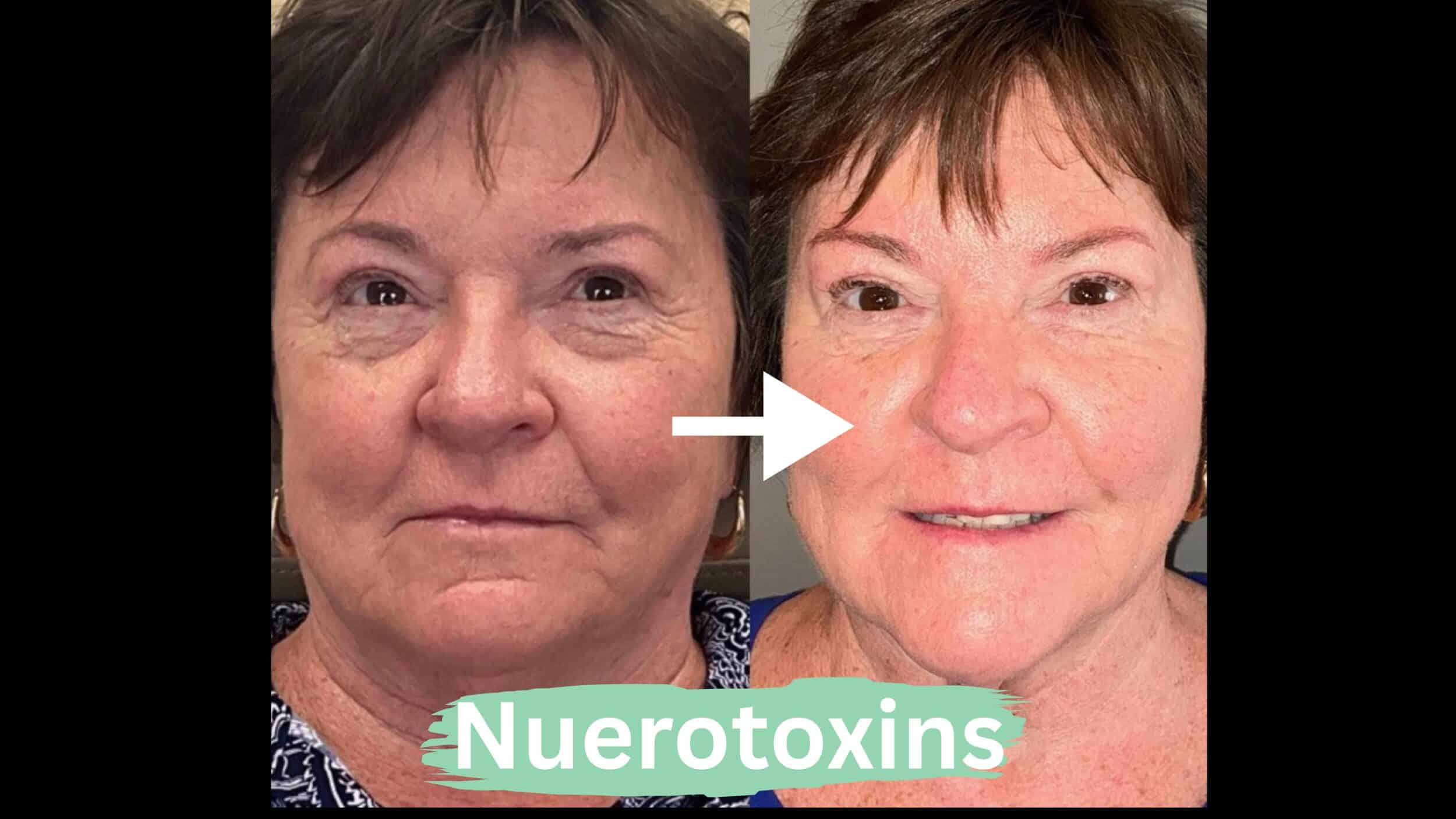 Before and After Image: Neurotoxins - front