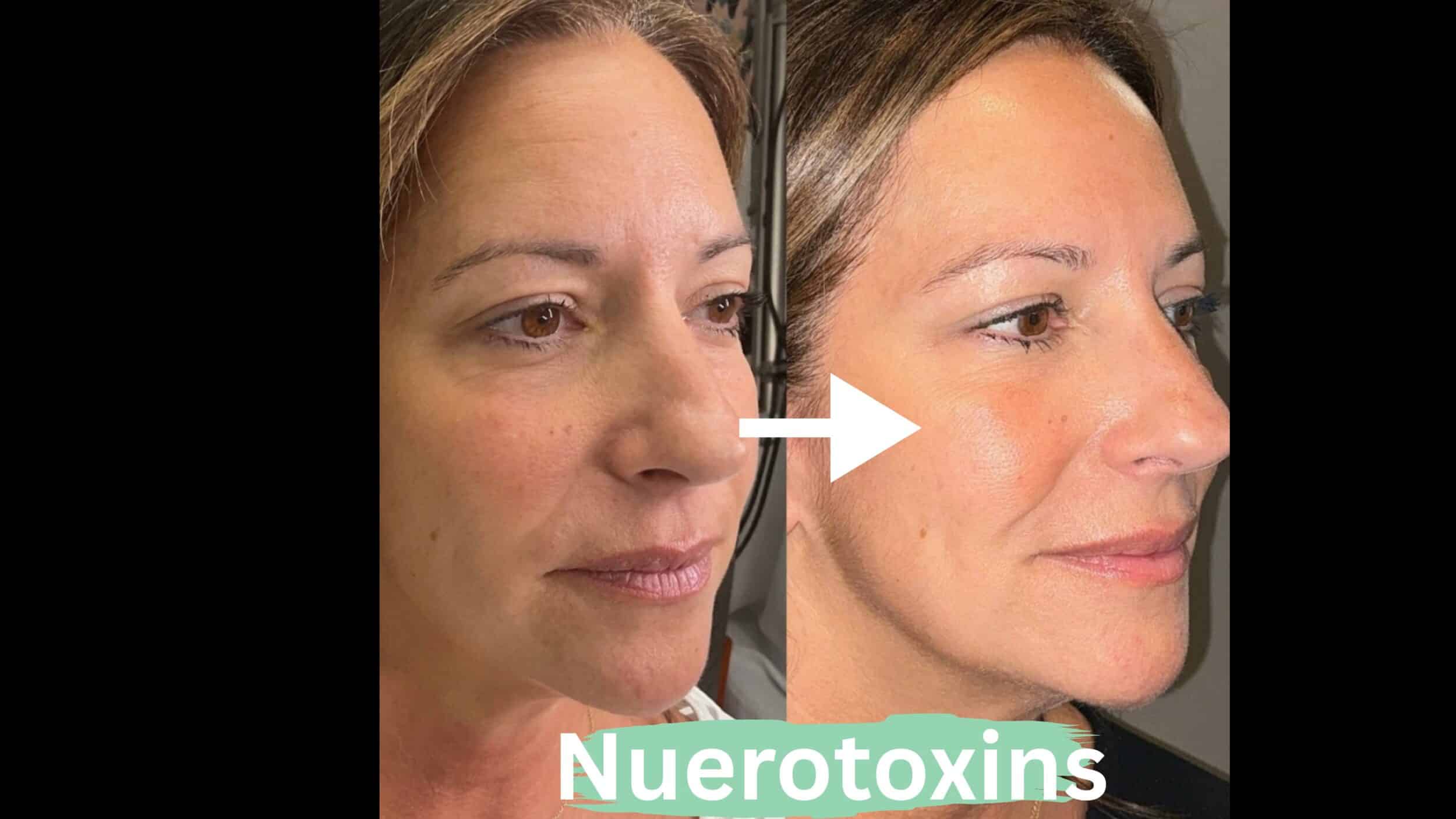 Before and After Image: Neurotoxins - right-front-oblique