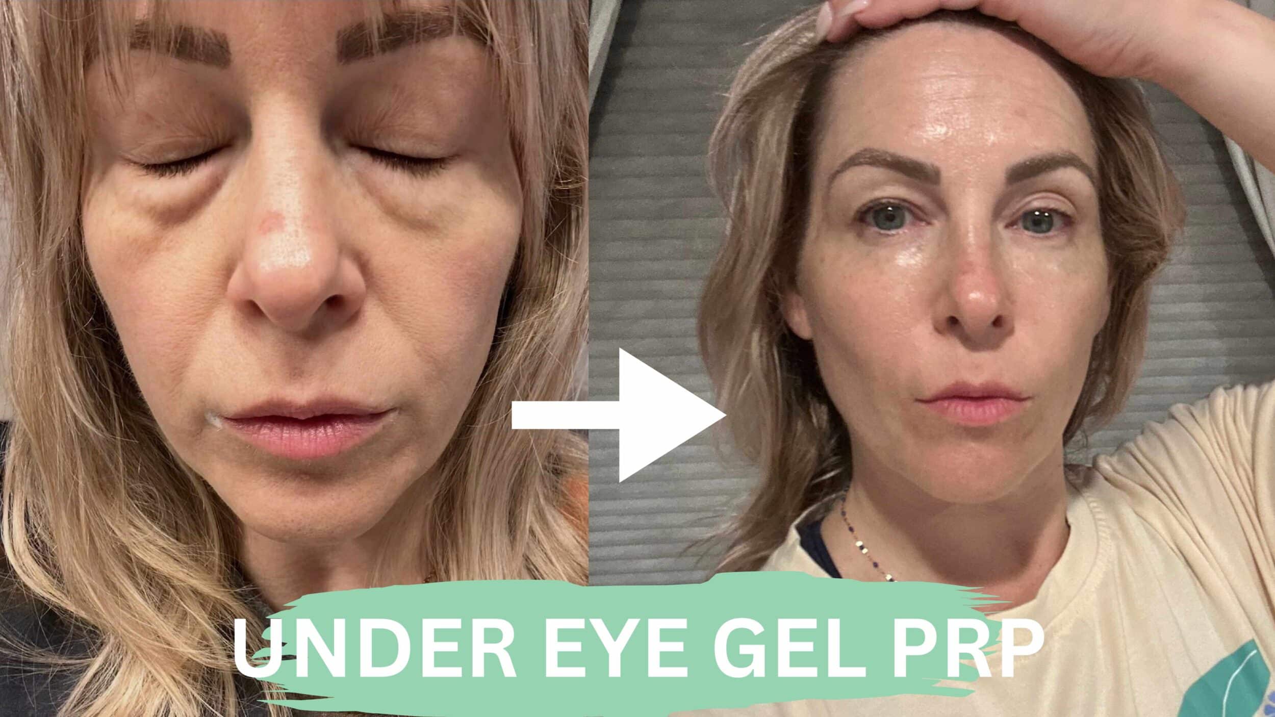 Before and After Image: Under Eye Gel PRP - front