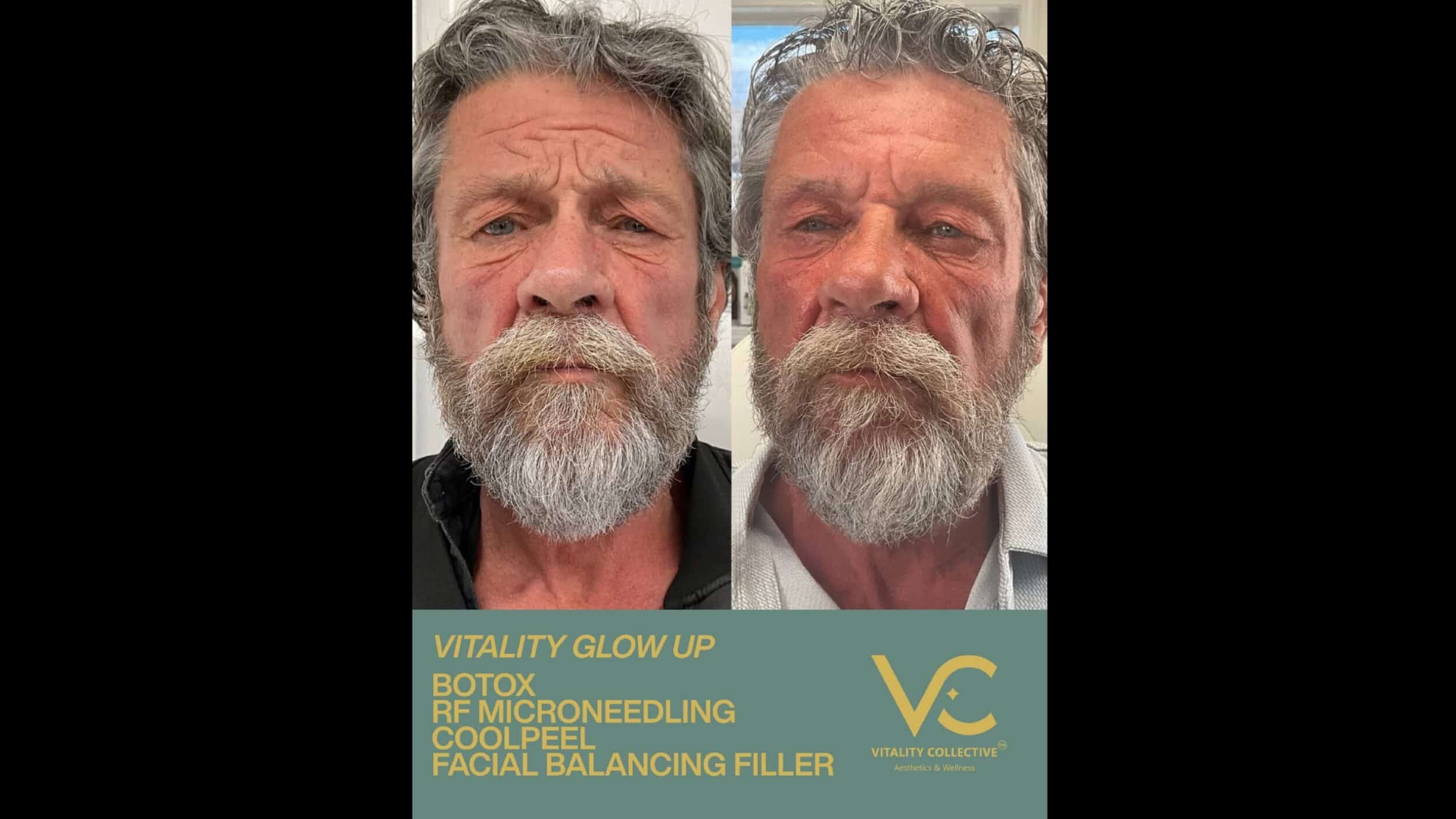 Before and After Image: Vitality Glowup – Botox, RF Microneedling, CoolPeel, Facial Balancing Filler - front