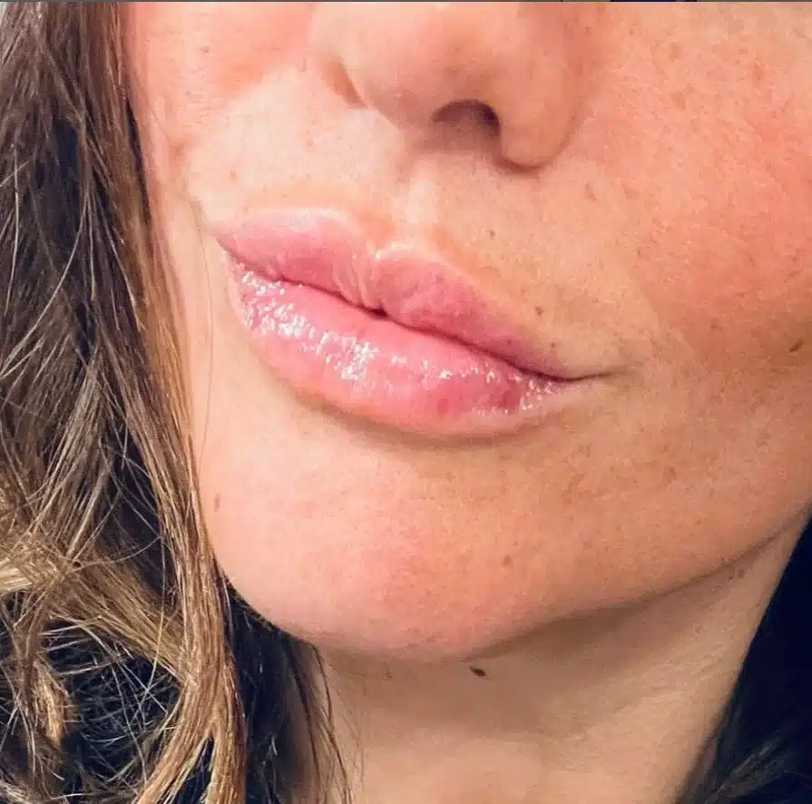 Enhanced lips after Lips+ or Restylane Kysse treatment.